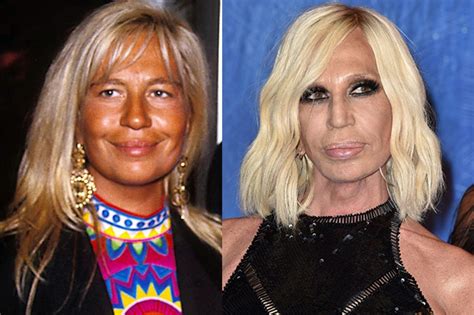 antonella versace e chirurgia